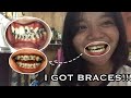 I GOT BRACES (Philippines) | Hazel