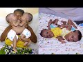 Watching Our Conjoined twins Take Their Last Breath : THIS VIDEO WILL MAKE YOU CRY