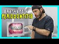 Cuando⛔️NO⛔️ USAR BRACKETS. Llevar ORTODONCIA en PACIENTES PERIODONTALES ¿es posible?🤔