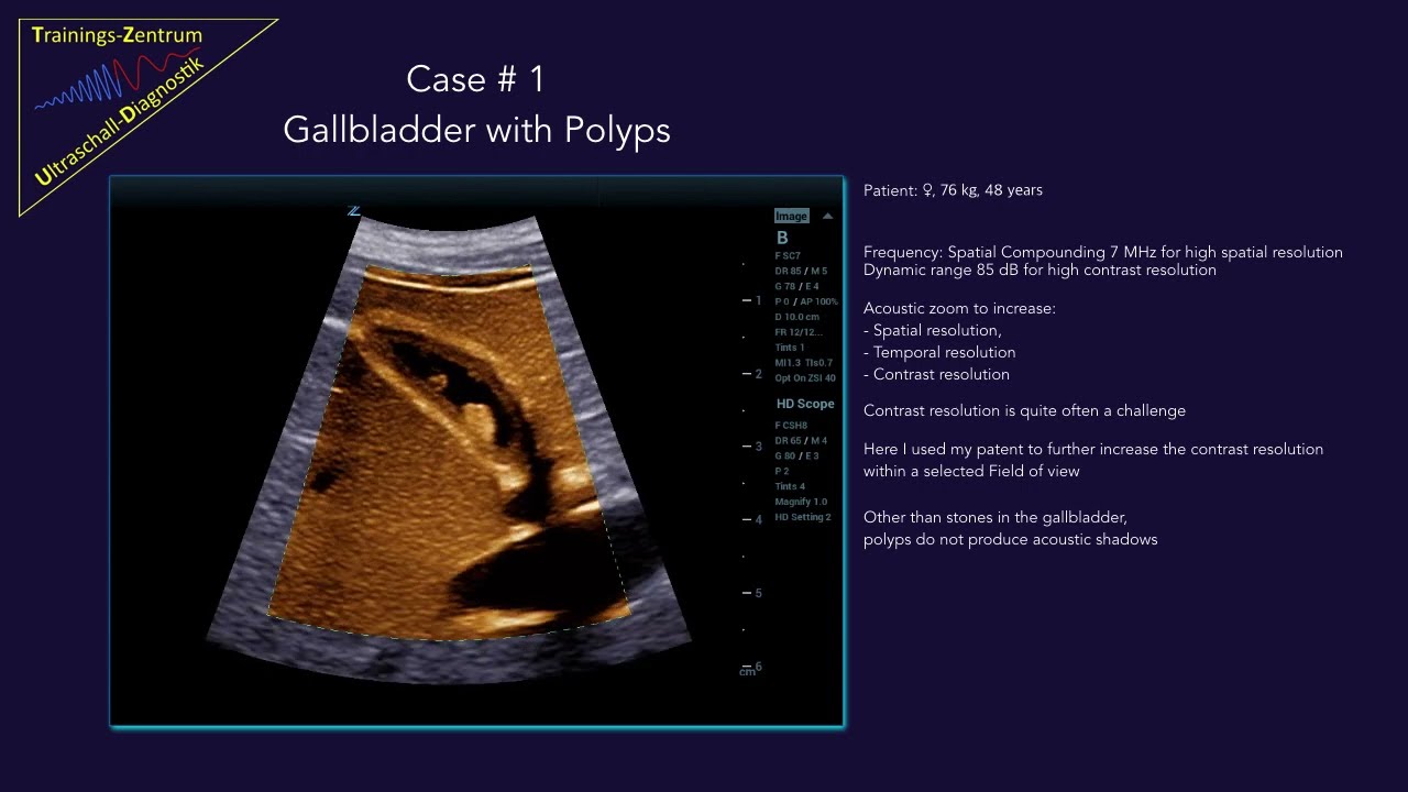 Case 1 Gallbladder Polyps