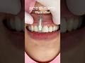 15 years after front tooth implant👍 #dental #dentist #smile #dentistry #esthetic