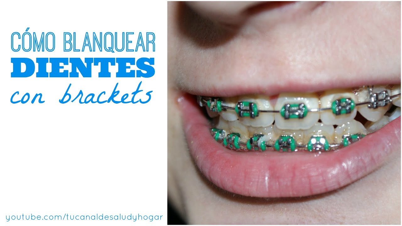 Introducir 47+ imagen recetas caseras para blanquear los dientes con brackets