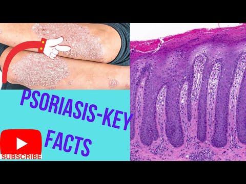 Psoriasis-Causes, Types, Sign and Symptoms,Diagnosis and Treatment.Psoriasis-key facts