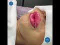 #увеличениегуб #аугментациягуб #алматы