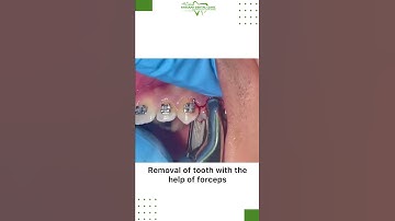 Orthodontics tooth extraction #shorts (2022)