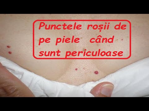 🍀Punctele roșii de pe piele – când sunt periculoase🔔