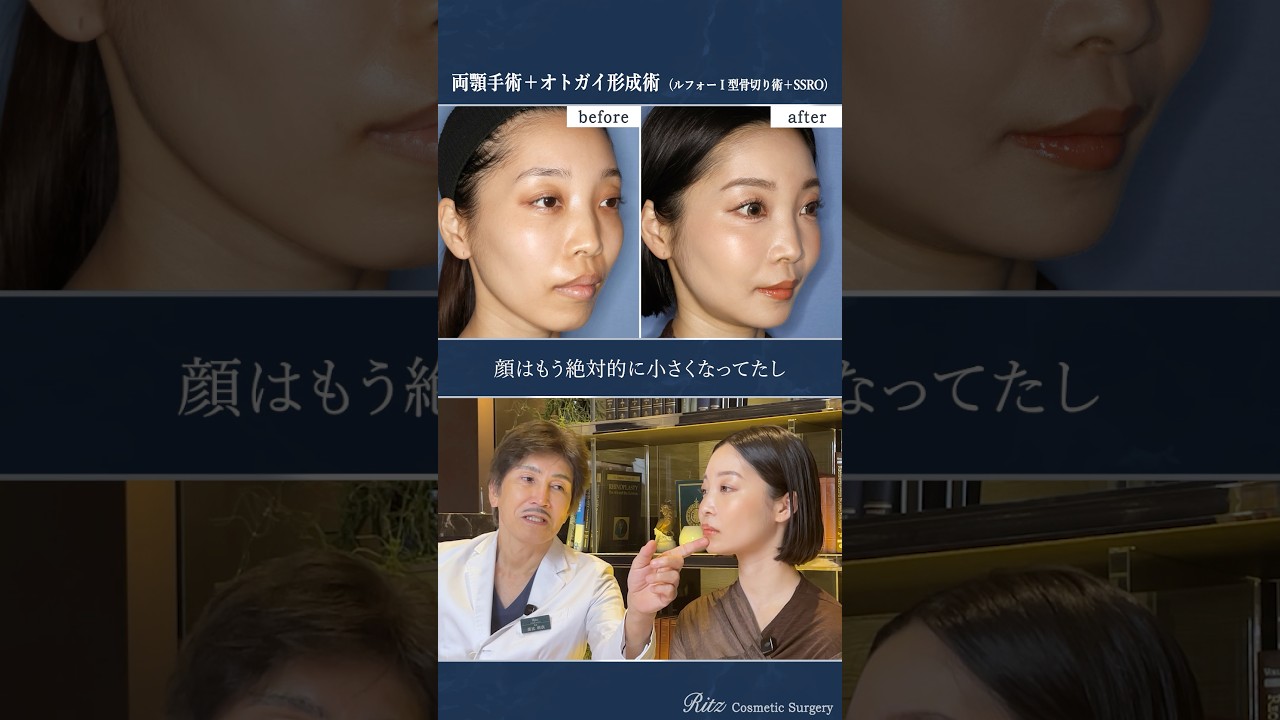 骨切り手術を受けた女性にインタビュー!#骨切り #美容整形 #両顎手術 #shorts
