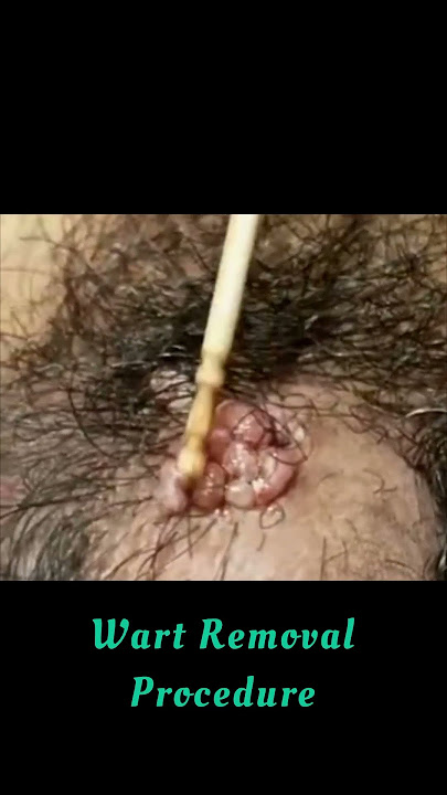 Genital warts Treatment #skincare #drashimagoel #parisaskinclinic #dermatologist