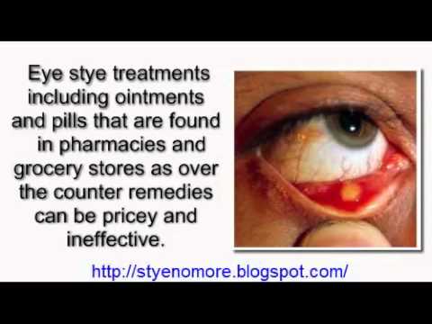 How To Cure A Stye In Your Eye Naturally How To Cure A Stye In Your Eye Naturally