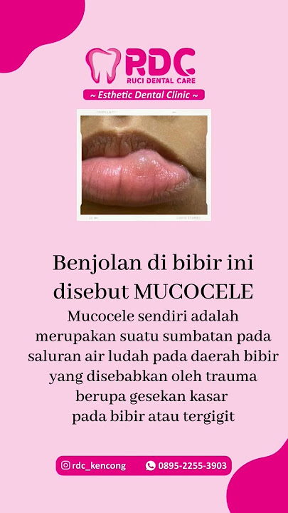 bahaya gak sih ada benjolan di bibir??? #doktergigi #gigisehat #kesehatangigi #doktermuda