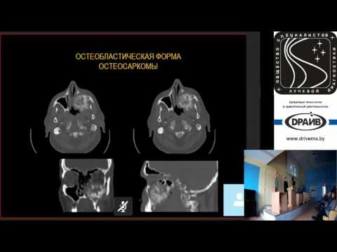 Дифференциальная диагностика злокачественных опухолей костей: злокачественные образования