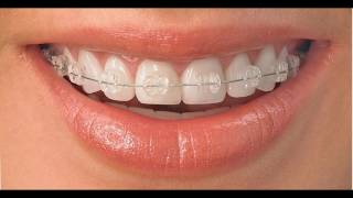 Rose ِِClinic  تقويم الاسنان المعوجة سبليمنال مضاعف التأثير