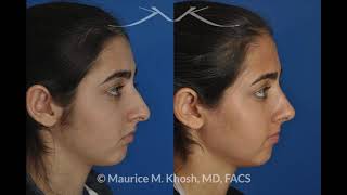 NYC Droopy Nasal Tip Correction | UES Droopy Tip Rhinoplasty | Dr. Khosh Facial Plastic Surgeon