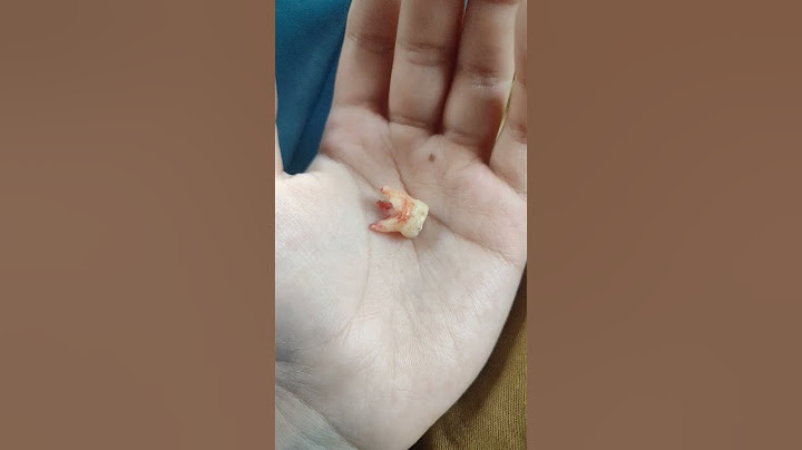 my tooth came out