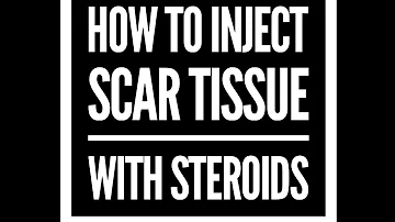 How to inject scar tissue with Steroids