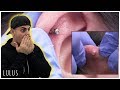Massive Crust Build Up On Ear Piercing!! *Removal* | Ep.  369