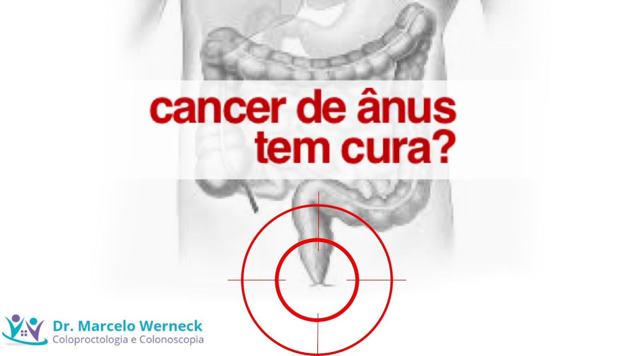 Câncer de ânus tem cura? YouTube Câncer de ânus tem cura? YouTube