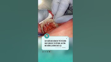 Lựa chọn tốt cho người hay quên đeo hàm duy trì  #nhakhoa #niengrang #nhatkyniengrang  #viral