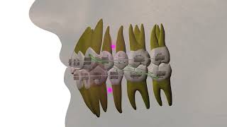 Long class II elastic