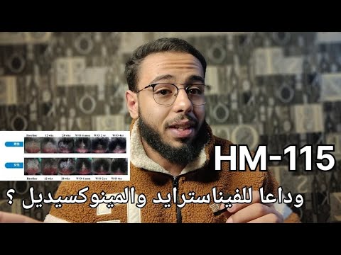 طفرة جديدة في علاج الصلع الوراثي  115