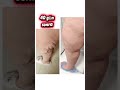 endovenoz lazer ablasiya varikoz damarlar tibb üzrə fəlsəfə doktoru ismayil esgerov əməliyyat sonra