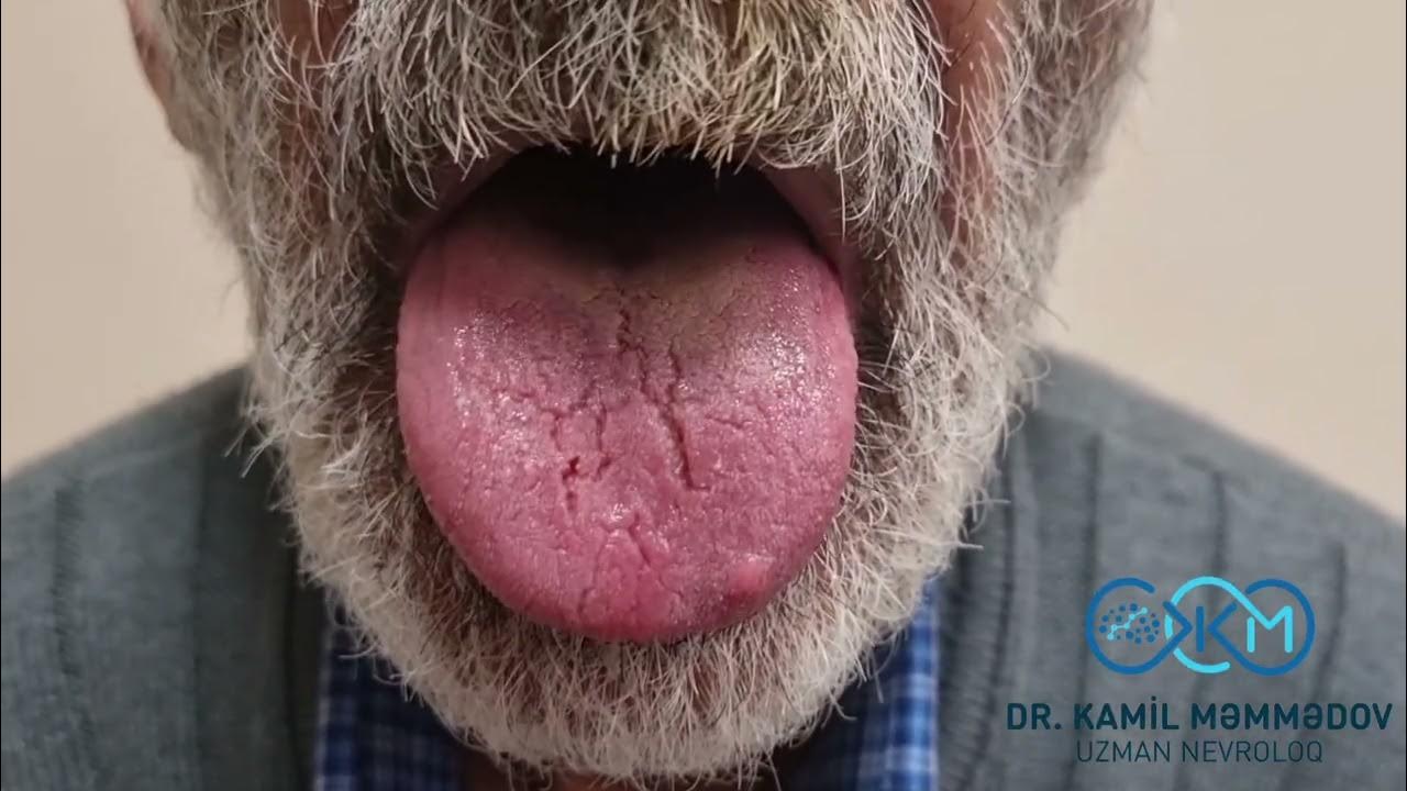 Tongue Tremor (Dil Tremoru) Uzman Nevroloq Dr.Kamil Məmmədov YouTube