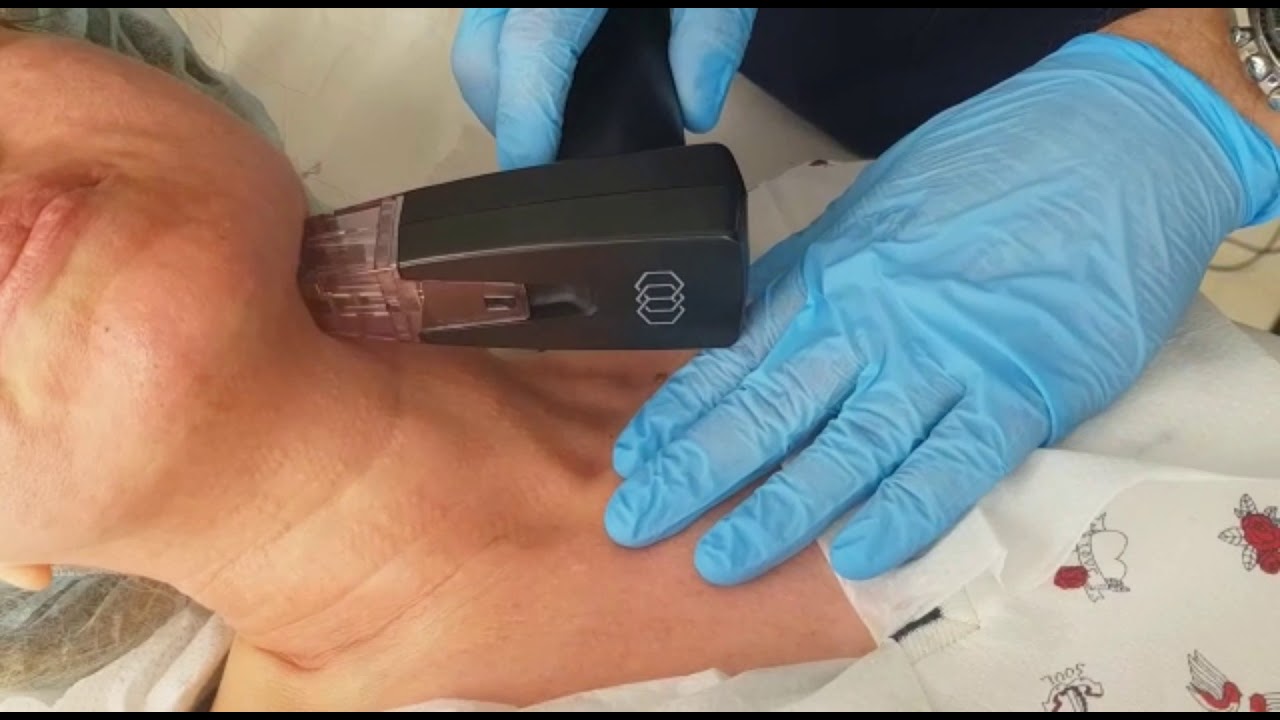 Tratamiento Morpheus8 en cuello y escote