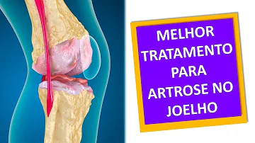 Como é a fisioterapia para quem tem artrose?