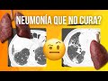 ¿Por qué la neumonía no mejora? Descubre diagnosticos alternativos!
