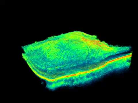 Topcon 3D OCT Epiretinal Membrane YouTube Topcon 3D OCT Epiretinal Membrane YouTube