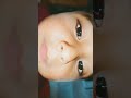 los ojos de Alan son diferente