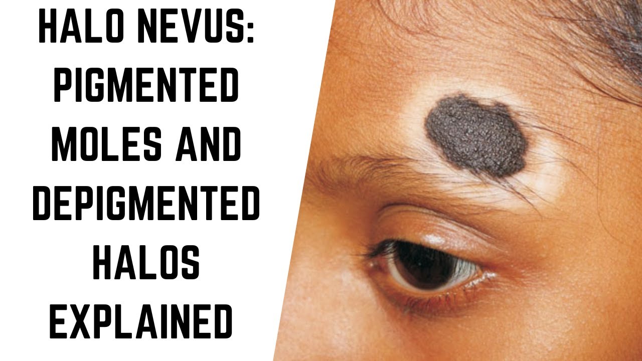 understanding-halo-nevus-pigmented-moles-and-depigmented-halos