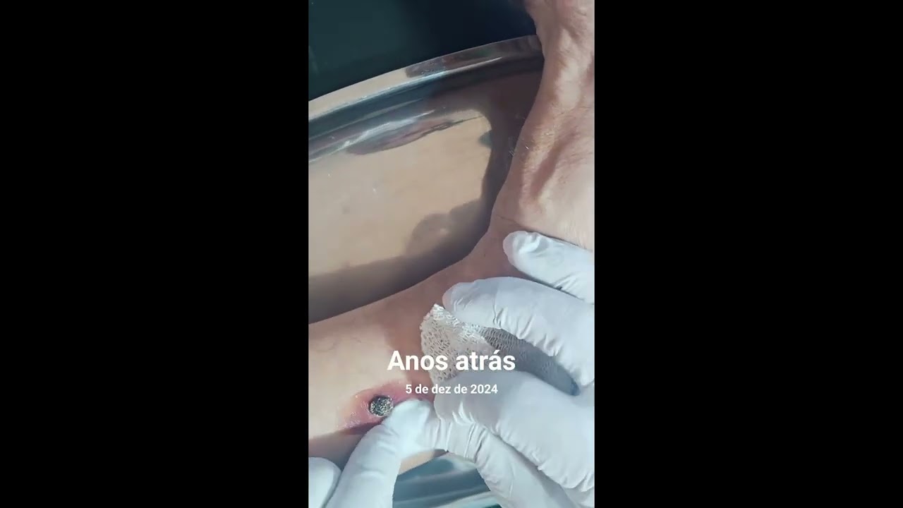 Botfly Maggot Removal 