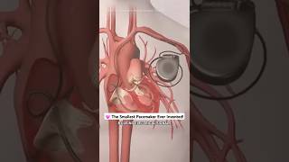 The World’s Smallest Pacemaker That Can Save Lives