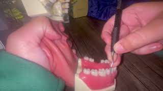 UNIVERSAL CURETTE VS GRACEYS