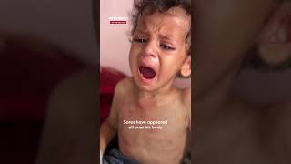 Palestinian Mother Pleads For His Son Suffering Skin Ulcers From Malnutrition