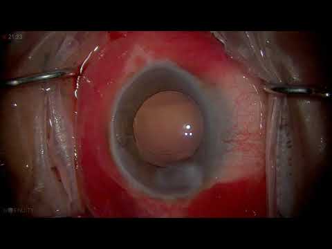 Video: Brydningsresultater Blandt Glaukomepatienter, Der Gennemgår Phacoemulsification Kataraktekstraktion Med Og Uden Kahook Dual Blade Goniotomy