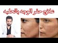 علاج حفر الوجه بالحلبه، المينوكسيديل في رمضان - دكتور طلال المحيسن
