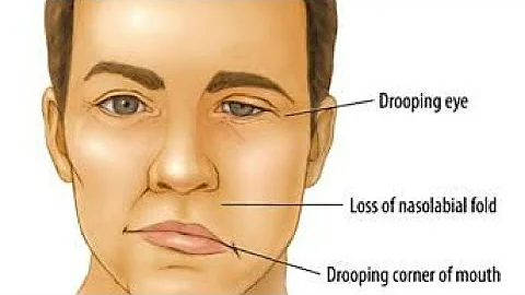 Crossed vs Uncrossed Hemiplegia