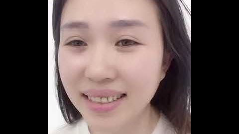 Răng sứ thẩm mỹ | Tự tin với nụ cười mới