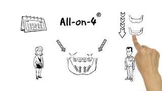 What is All-on-4 Dental Implants? How is All on 4 done?