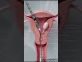Inside the uterus, tiny growths like fibroids or polyps can silently affect a woman's #dr_couples143