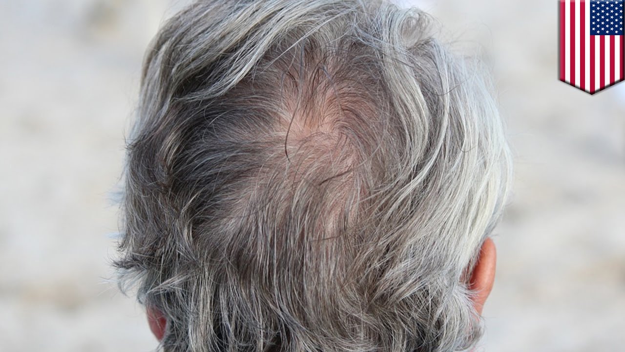 Scientists Find Another Possible Explanation for Why Hair Goes Gray