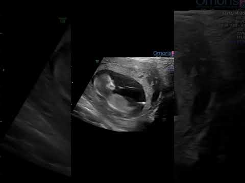 Vídeo: Como fazer um bebê se mexer para fazer um ultrassom: 7 etapas