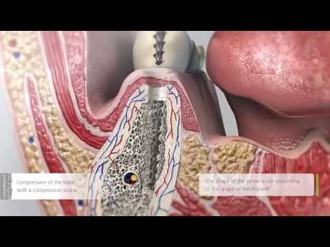 Video: Implant Pentru Fiecare Zi - Vedere Alternativă