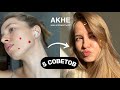 Как избавиться от прыщей? Акне-мой путь к чистой коже | Уход за кожей