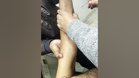 Dr. Subhayan Mandal- Botulinum toxin for post stroke spasticity.(1)