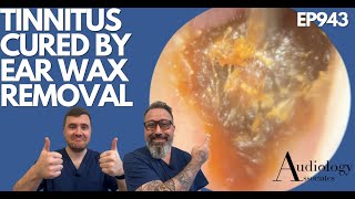 TINNITUS CURED BY EAR WAX REMOVAL - EP943