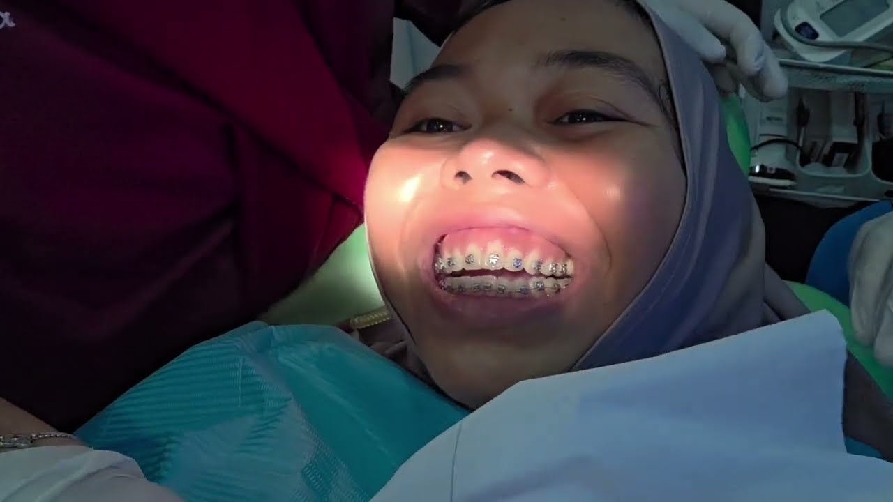 Perdana kontrol behel ⁉️ mati lampu galang lari terbirit