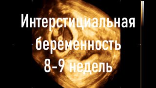 Интерстициальная беременность 8-9 недель